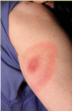 Telltale bullseye rash is an obvious indicator of Lyme disease.
