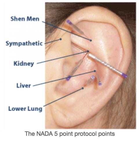 NADA auricular acupuncture